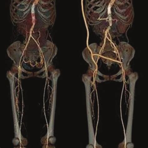 A Enhanced Computed Tomography Shows That Descending Aorta Is Download Scientific Diagram