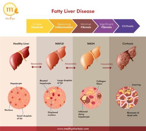 The Best Fatty Liver Diet Plan For Natural Treatment