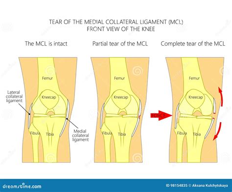 Ligaments of the Knee_Tear of the Medial Collateral Ligament Stock ...