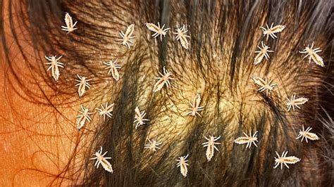 Biggest Lice Infestations Of All Time Head Lice Facts Youtube