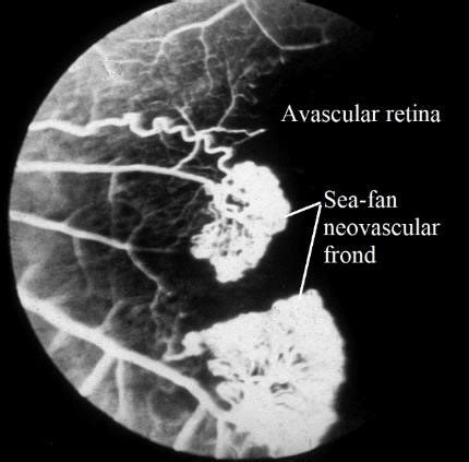 Sclerosed Retinal Vessel