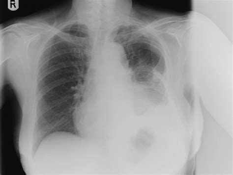 A Year Old Lady With Chronic Cough And A Discharging Chest Wall