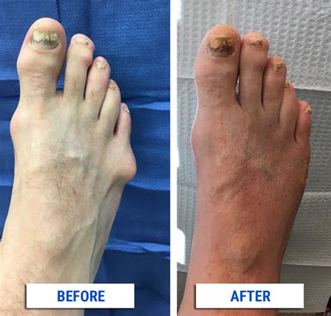 Bunion Correction Alpine Foot Specialists