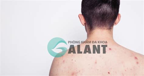 Biểu Hiện Hiv Giai đoạn Cuối Như Thế Nào