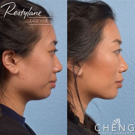 Chin Filler Before And After Photos The Daily Glimmer