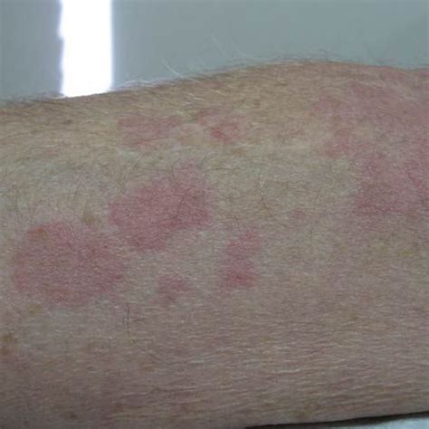 Gallery Of Hives Pictures For Identifying Rashes