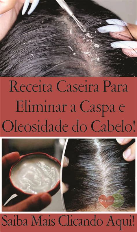 Receitas Caseiras Para Eliminar A Caspa E Oleosidade Do Cabelo Caspa