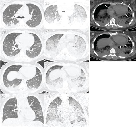 Postmortem Chest Computed Tomography In Fatal Covid 19 A Valuable