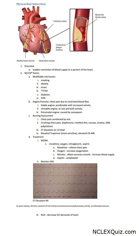 Nclex Points Myocardial Infarction Nclex Quiz