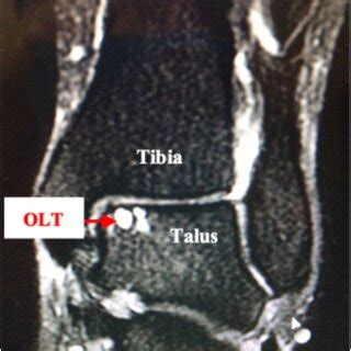 mri  osteochondral lesion image obtained  dr david pedowitz
