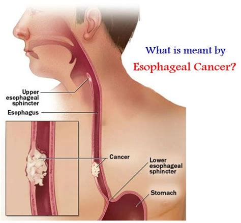 What Is Meant By Esophageal Cancer? | by Healthcare 800 | Medium