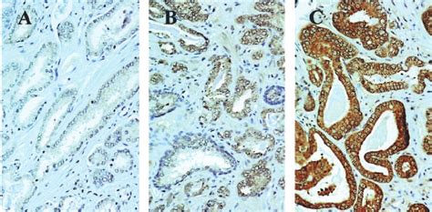 Immunohistochemical Staining Of Prostate Cancer Tissues With