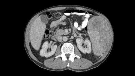 New Standard of Care in Rhabdomyosarcoma?