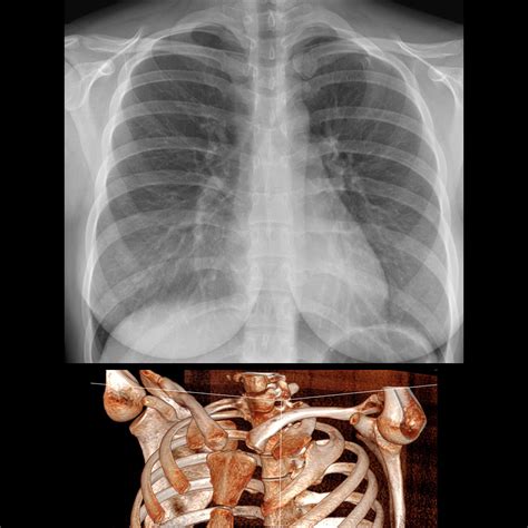 Pediatric Rib Fusion Pediatric Radiology Reference Article