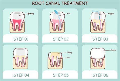 How To Know You Need A Root Canal In Rockledge Premier Walk In Dental