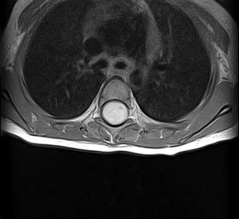 Ependymoma Spinal Cord Image