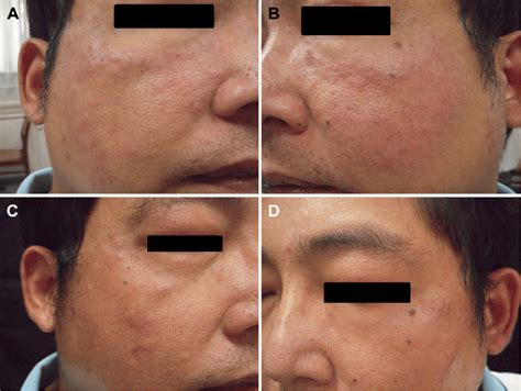 Multiple Reddish Papules And Plaques Arranged In Annular Shape With Download Scientific Diagram