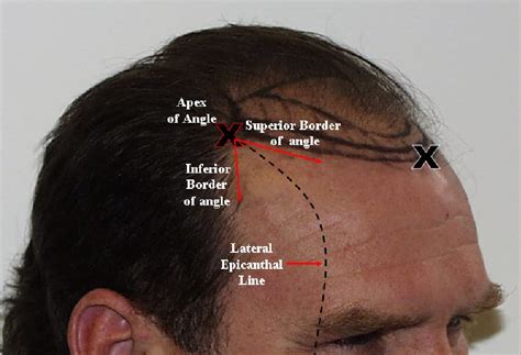 Surgical Hair Restoration Shapiro Medical Group