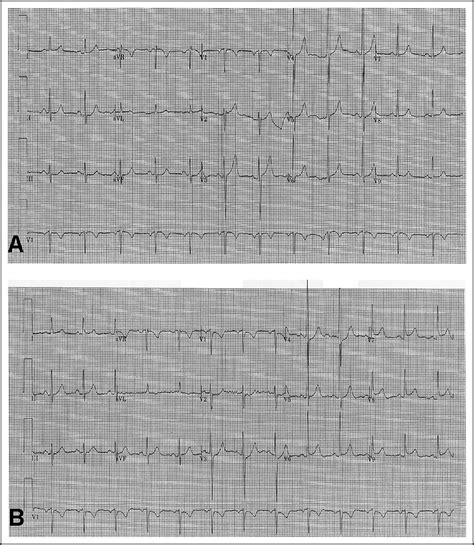 Usefulness Of Three Posterior Chest Leads For The Detection Of