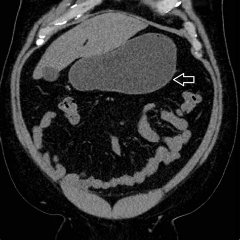 Multiple small and large mouthed diverticula in the sigmoid colon and ...