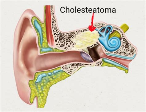 Cholesteatoma Ear Surgery