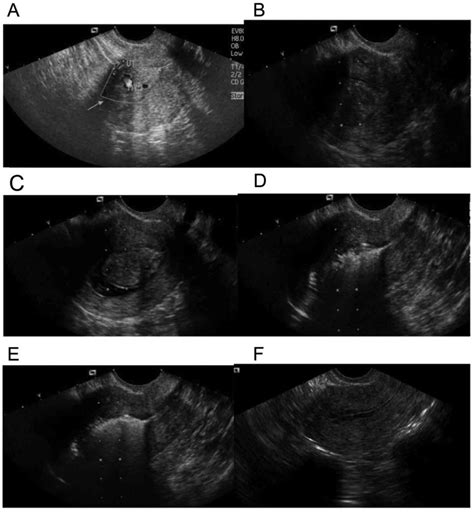 Diagnosis And Treatment Of Submucous Myoma Of The Uterus With