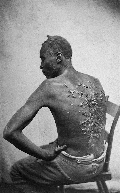 A Former Slave Named Gordon Shows His Whipping Scars Baton Rouge