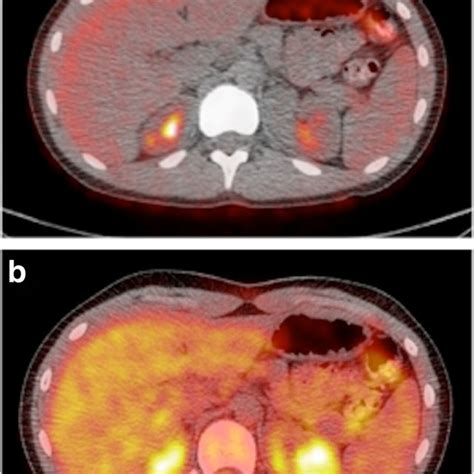 Contrast Enhanced Low Dose Attenuation Correction Ct From Petct Exam