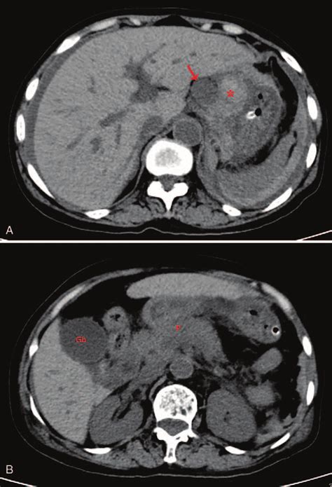 A Plain Ct Abdomen Showing Hypodense Mass Lesion Around The Coeliac