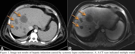 Figure 2 From Hepatic Infarction Caused By Antiphospholipid Syndrome