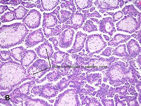 American Urological Association Papillary Renal Cell Carcinoma