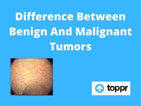 Benign Tumor