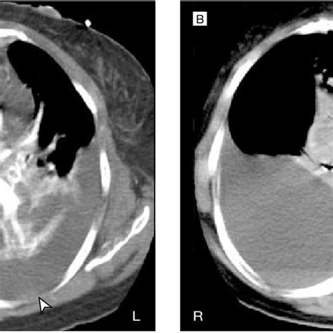 Spiral Computed Tomography Of The Chest And 20 Minute Delayed Image