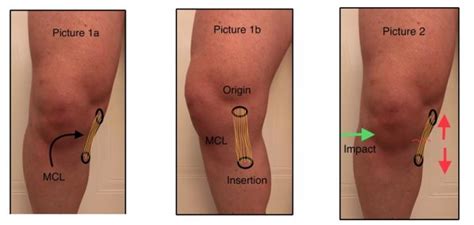 Physiotherapy Spotlight Knee Mcl Tears Sprains All For One