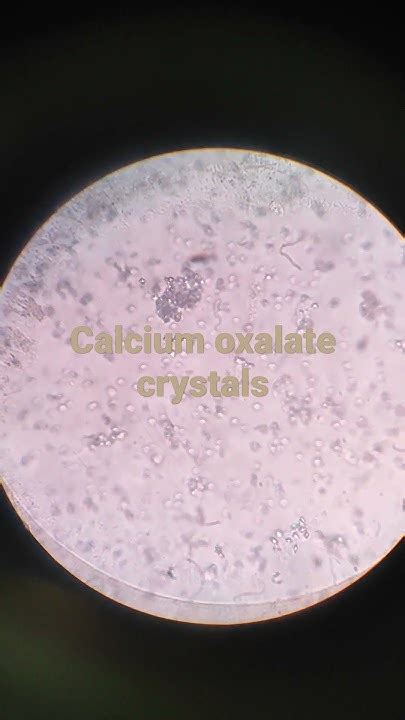 Calcium Oxalate Crystals Under Microscope Urine Examination Medicallabtechnologysajal6903