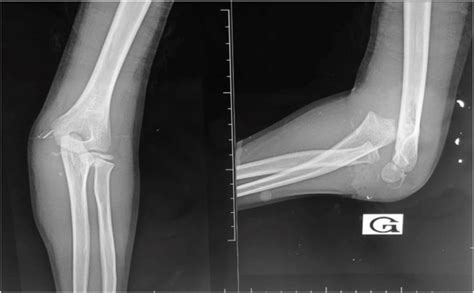 Standard X Ray Of The Left Elbow In Antero Posterior And Lateral Views