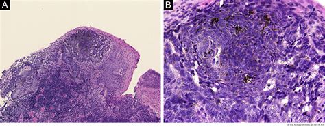 A Case Of Basal Cell Carcinoma Arising In The Umbilicus Anais