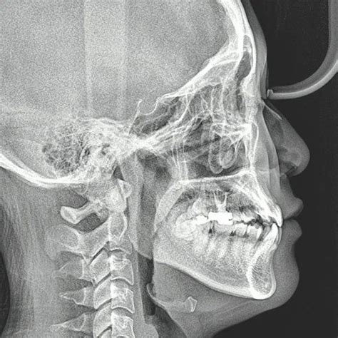 Imaging Range Genoray Papaya 3d Plus Cbct Distributor Channel