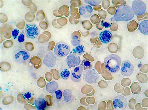 Sideroblastic Anemia Storymd