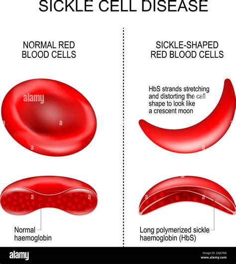 Sickle Red Blood Cell