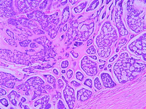 Adenoid Cystic Carcinoma Histopathology Guru