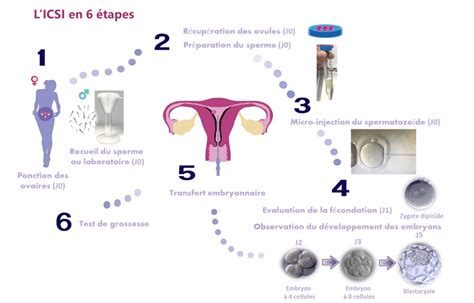 Centre Avignon ICSI injection intra cytoplasmique de spermatozoïde