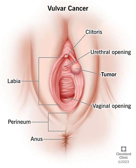 Vulvar Cancer Symptoms Causes Treatment 60 OFF