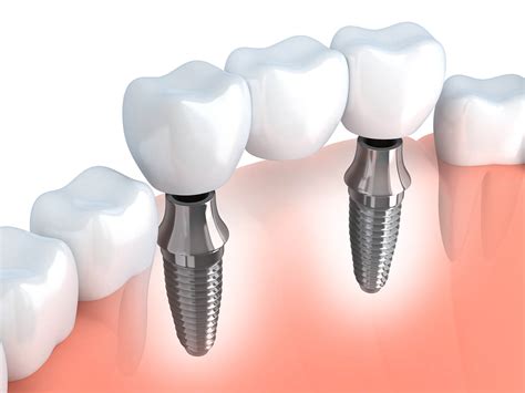 TOP 5 Questions About Dental Implants – Answered!