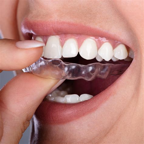 Before Getting Invisalign Orthodontic Treatment Knoxville