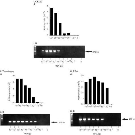 Amplification Of I CK 20 Ii Tyrosinase And Iii PSA MRNA In