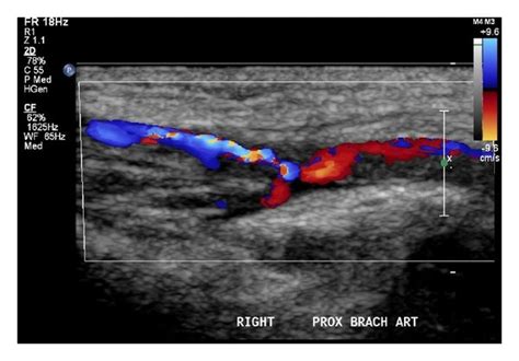 Brachial Vein Ultrasound