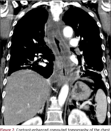 tonsil abscess | Semantic Scholar