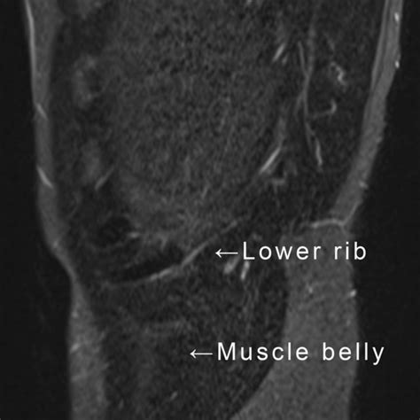 Sagittal And Axial Mri Of Internal Oblique Muscle Strain On Sagittal