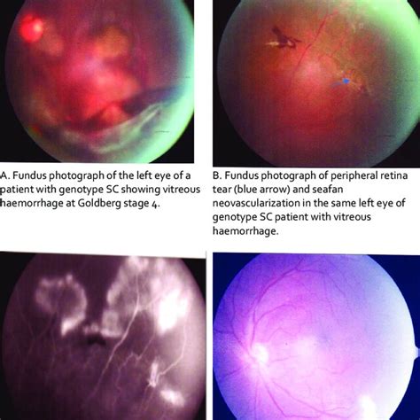 Fundus Photographs And Fluorescein Angiogram Of Left Eye Of Patient